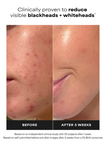 PAULA'S CHOICE SKIN PERFECTING 2% BHA Liquid Exfoliant