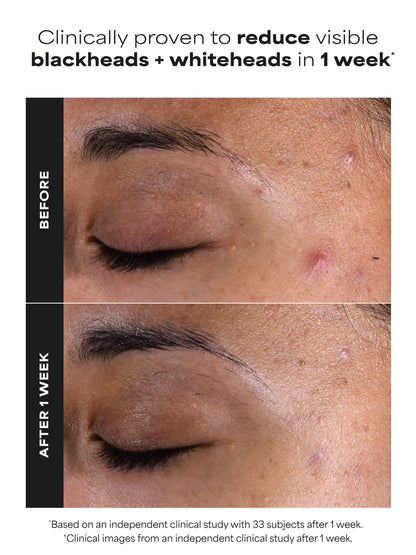 PAULA'S CHOICE SKIN PERFECTING 2% BHA Liquid Exfoliant